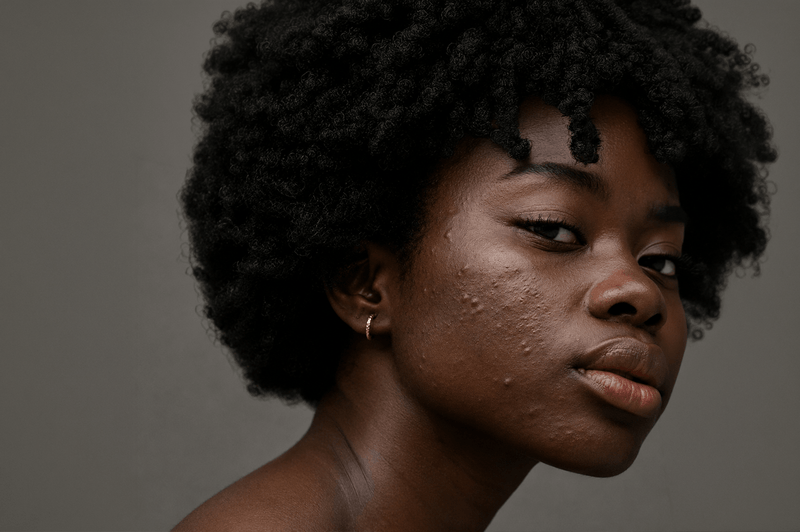 Close-up editorial portrait of a woman with visible acne, natural skin texture, and unretouched complexion. Soft lighting reveals authentic detail and celebrates real skin with confidence, honesty, and understated beauty.
